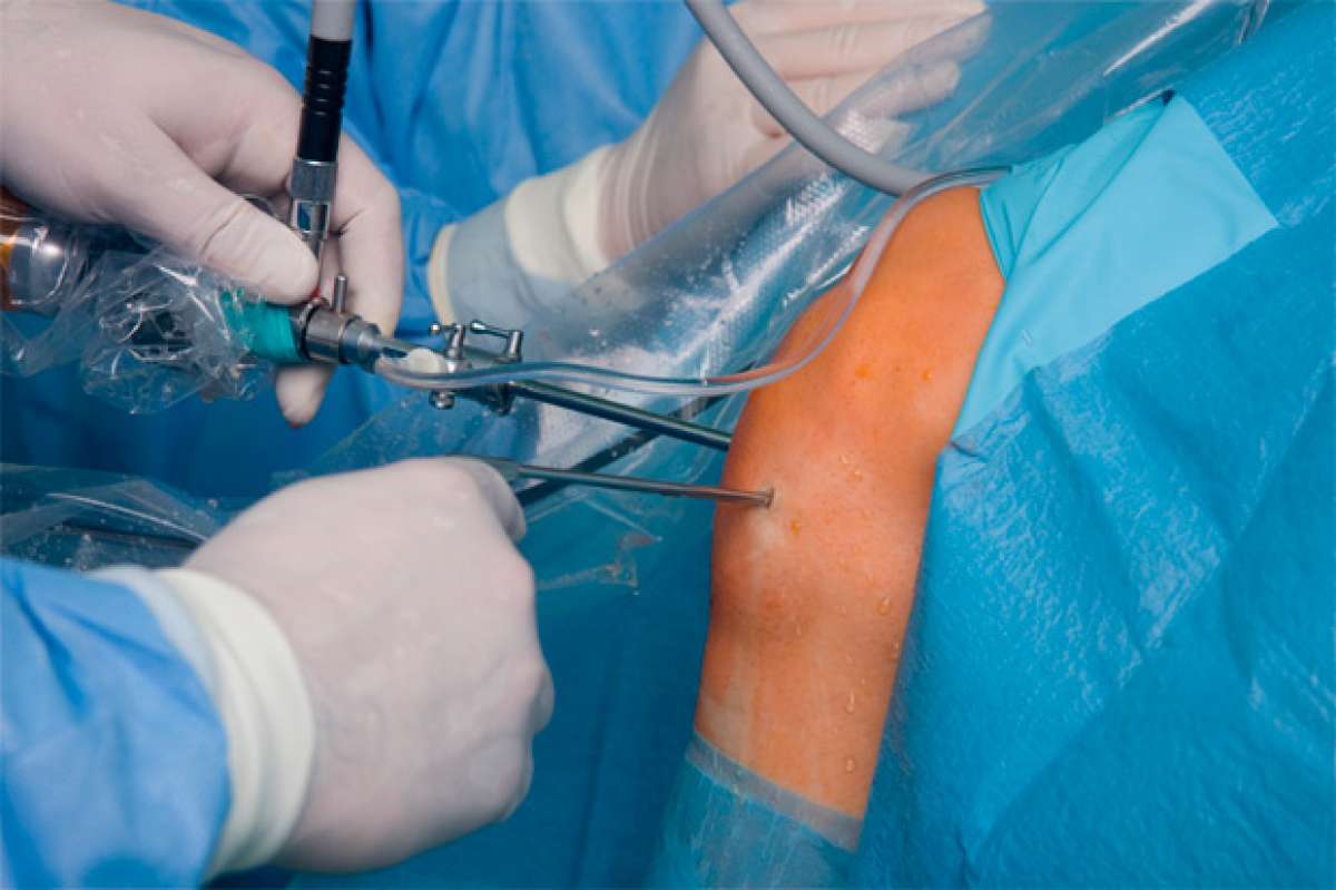 Así se realiza una operación de rodilla por artroscopia