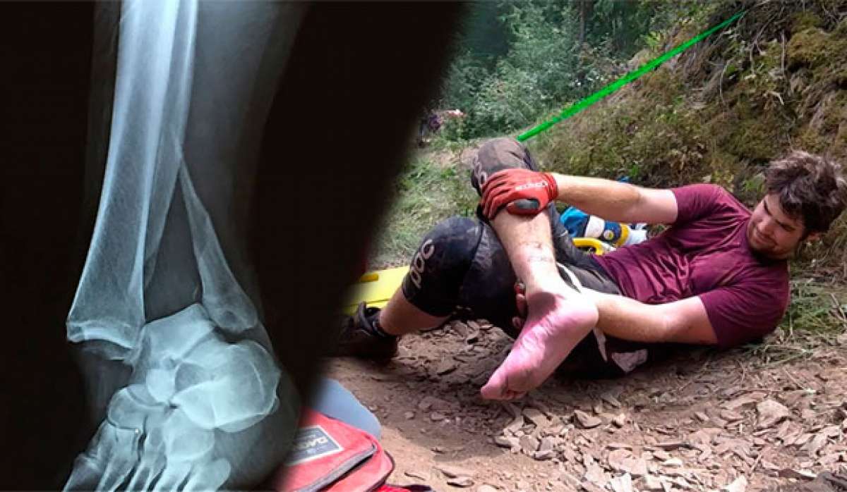 Así de fácil se rompe un tobillo en una caída "tonta" sobre una bicicleta