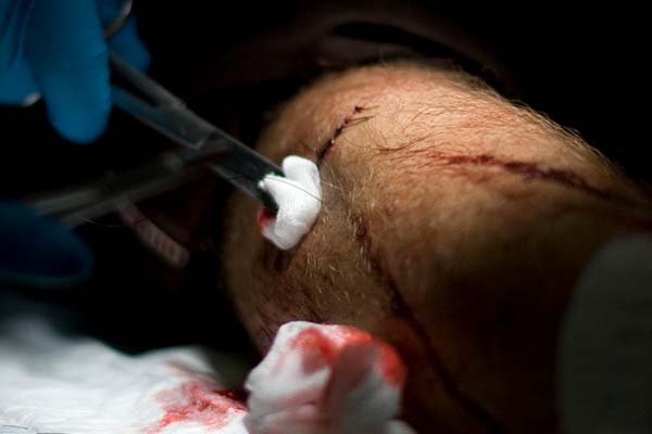 Cómo curar correctamente las heridas producidas sobre la bicicleta para prevenir cicatrices e infecciones