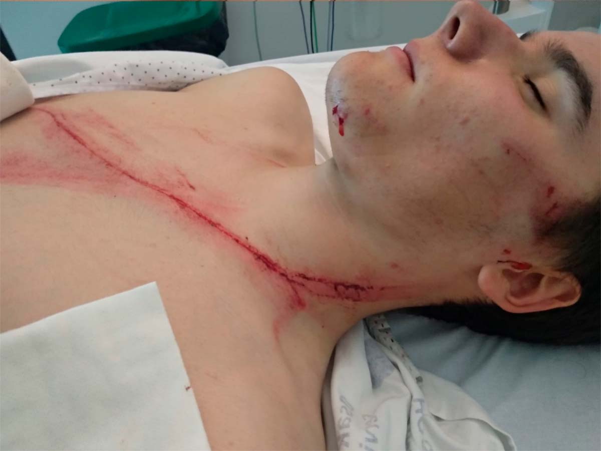 Esto es lo que un guardarrail le hace a un ciclista, si tiene suerte para contarlo