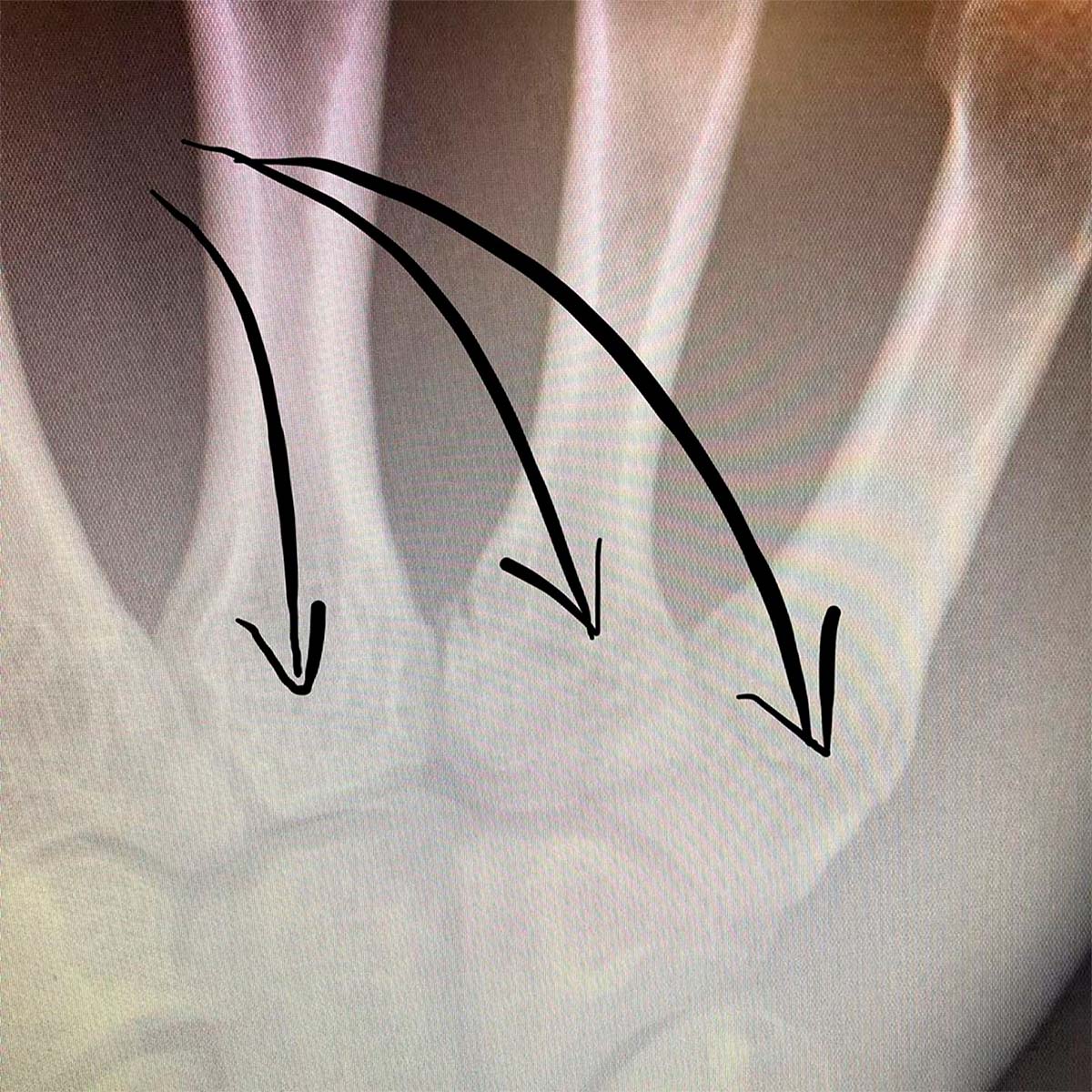 En TodoMountainBike: La mala suerte se ceba con Annika Langvad: se fractura el omóplato y la mano en una carrera local