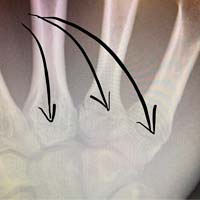 La mala suerte se ceba con Annika Langvad: se fractura el omóplato y la mano en una carrera local