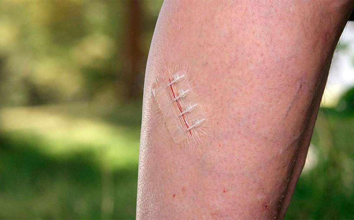 Urgostrips puntos de aproximación ayudan a cerrar pequeñas heridas